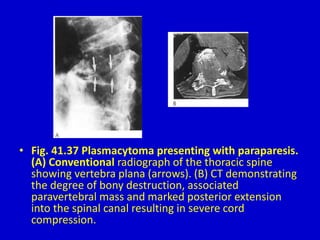 • Fig. 41.37 Plasmacytoma presenting with paraparesis.
(A) Conventional radiograph of the thoracic spine
showing vertebra plana (arrows). (B) CT demonstrating
the degree of bony destruction, associated
paravertebral mass and marked posterior extension
into the spinal canal resulting in severe cord
compression.
 