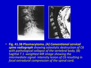 • Fig. 41.38 Plasmacytoma. (A) Conventional cervical
spine radiograph showing osteolytic destruction of C6
with pathological collapse of the vertebral body. (B)
Sagittal T 1 -weighted MR image showing the
intermediate signal- intensity lesion of C6 resulting in
focal extradural compression of the spinal cord.
 