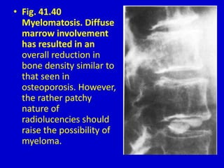 • Fig. 41.40
Myelomatosis. Diffuse
marrow involvement
has resulted in an
overall reduction in
bone density similar to
that seen in
osteoporosis. However,
the rather patchy
nature of
radiolucencies should
raise the possibility of
myeloma.
 