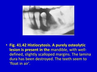 • Fig. 41.42 Histiocytosis. A purely osteolytic
lesion is present in the mandible, with well-
defined, slightly scalloped margins. The lamina
dura has been destroyed. The teeth seem to
'float in air'.
 