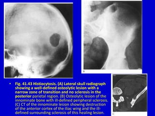 • Fig. 41.43 Histiocytosis. (A) Lateral skull radiograph
showing a well-defined osteolytic lesion with a
narrow zone of transition and no sclerosis in the
posterior parietal region. (B) Osteolytic lesion of the
innominate bone with ill-defined peripheral sclerosis.
(C) CT of the innominate lesion showing destruction
of the anterior cortex of the iliac wing and the ill-
defined surrounding sclerosis of this healing lesion.
 