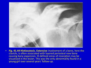 • Fig. 41.44 Histiocytosis. Extensive involvement of a bone, here the
clavicle, is often associated with layered periosteal new bone
causing bony expansion. Ill-defined areas of resorption may be
visualised in the lesion. This was the only abnormality found in a
young girl over several years' follow-up.
 