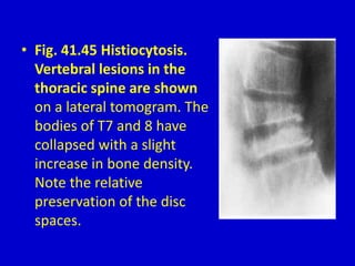 • Fig. 41.45 Histiocytosis.
Vertebral lesions in the
thoracic spine are shown
on a lateral tomogram. The
bodies of T7 and 8 have
collapsed with a slight
increase in bone density.
Note the relative
preservation of the disc
spaces.
 