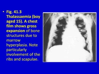 • Fig. 41.3
Thalassaemia (boy
aged 15). A chest
film shows gross
expansion of bone
structures due to
marrow
hyperplasia. Note
particularly
involvement of the
ribs and scapulae.
 