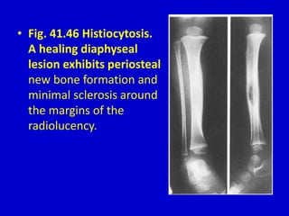 • Fig. 41.46 Histiocytosis.
A healing diaphyseal
lesion exhibits periosteal
new bone formation and
minimal sclerosis around
the margins of the
radiolucency.
 