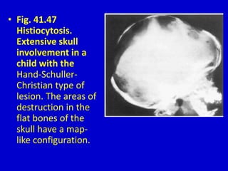 • Fig. 41.47
Histiocytosis.
Extensive skull
involvement in a
child with the
Hand-Schuller-
Christian type of
lesion. The areas of
destruction in the
flat bones of the
skull have a map-
like configuration.
 
