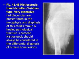 • Fig. 41.48 Histiocytosis:
Hand-Schuller-Christian
type. Very extensive
radiolucencies are
present both in the
metaphysis and diaphysis
of this child's femur. A
healed pathological
fracture is present.
Histiocytosis should
always be considered in
the differential diagnosis
of bizarre bone lesions.
 
