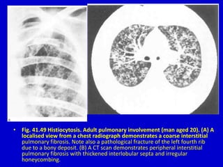 • Fig. 41.49 Histiocytosis. Adult pulmonary involvement (man aged 20). (A) A
localised view from a chest radiograph demonstrates a coarse interstitial
pulmonary fibrosis. Note also a pathological fracture of the left fourth rib
due to a bony deposit. (B) A CT scan demonstrates peripheral interstitial
pulmonary fibrosis with thickened interlobular septa and irregular
honeycombing.
 