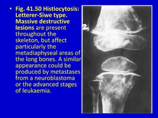 • Fig. 41.50 Histiocytosis:
Letterer-Siwe type.
Massive destructive
lesions are present
throughout the
skeleton, but affect
particularly the
metadiaphyseal areas of
the long bones. A similar
appearance could be
produced by metastases
from a neuroblastoma
or the advanced stages
of leukaemia.
 