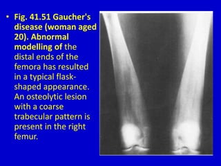 • Fig. 41.51 Gaucher's
disease (woman aged
20). Abnormal
modelling of the
distal ends of the
femora has resulted
in a typical flask-
shaped appearance.
An osteolytic lesion
with a coarse
trabecular pattern is
present in the right
femur.
 