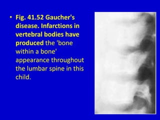 • Fig. 41.52 Gaucher's
disease. Infarctions in
vertebral bodies have
produced the 'bone
within a bone'
appearance throughout
the lumbar spine in this
child.
 