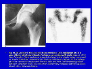 • Fig. 41.53 Gaucher's disease-acute bone infarction. (A) A radiograph of a 1 3-
year-old girl, with known Gaucher's disease, presenting with acute hip pain of 12
hours' duration. Slight endosteal sclerosis is shown in the inferior pubic ramus and
an area of ill-defined radiolucency in the intertrochanteric region. (B) The delayed
phase of a bone scan reveals the femoral head and neck to be markedly photon
deficient consistent with acute infarction. Abnormally increased activity is present
also at site of previous disease.
 