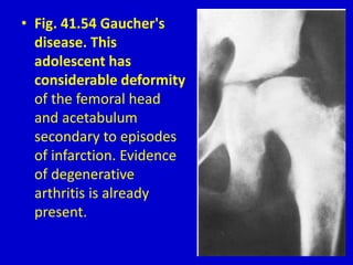 • Fig. 41.54 Gaucher's
disease. This
adolescent has
considerable deformity
of the femoral head
and acetabulum
secondary to episodes
of infarction. Evidence
of degenerative
arthritis is already
present.
 