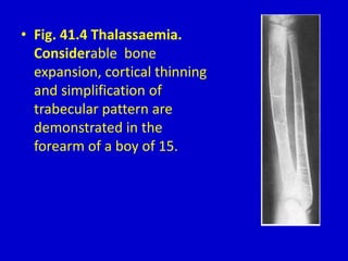 • Fig. 41.4 Thalassaemia.
Considerable bone
expansion, cortical thinning
and simplification of
trabecular pattern are
demonstrated in the
forearm of a boy of 15.
 