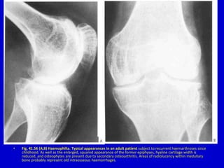 • Fig. 41.56 (A,B) Haemophilia. Typical appearances in an adult patient subject to recurrent haemarthroses since
childhood. As well as the enlarged, squared appearance of the former epiphyses, hyaline cartilage width is
reduced, and osteophytes are present due to secondary osteoarthritis. Areas of radiolucency within medullary
bone probably represent old intraosseous haemorrhages.
 