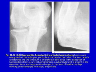 Fig. 41.57 (A,B) Haemophilia. Repeated intra-articular haemorrhages have caused
overgrowth of the epiphyses, particularly the head of the radius. The joint capsule
is distended and the synovium is amorphously dense due to the deposition of
haemosiderin from recurrent haemarthroses. A subarticular cyst is present in the
olecranon fossa, and degenerative changes, in the form of hyaline cartilage
thinning and osteophyte formation, are present.
 