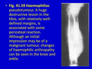 • Fig. 41.59 Haemophiliac
pseudotumour. A huge
destructive lesion in the
tibia, with relatively well-
defined margins, is
associated with some
periosteal reaction.
Although an initial
impression may be of a
malignant tumour, changes
of haemophilic arthropathy
can be seen in the knee and
ankle.
 
