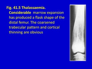 Fig. 41.5 Thalassaemia.
Considerable marrow expansion
has produced a flask shape of the
distal femur. The coarsened
trabecular pattern and cortical
thinning are obvious
 