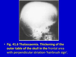 • Fig. 41.6 Thalassaemia. Thickening of the
outer table of the skull in the frontal area
with perpendicular striation-'hairbrush sign'.
 
