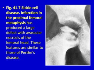 • Fig. 41.7 Sickle cell
disease. Infarction in
the proximal femoral
metaphysis has
produced a large
defect with avascular
necrosis of the
femoral head. These
features are similar to
those of Perthe's
disease.
 