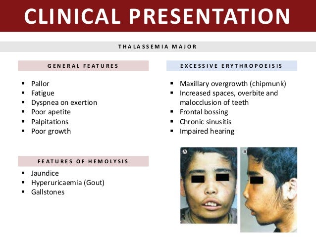 Thalassemia Face Features Chapter 12 Thalassemia Ppt Video Online