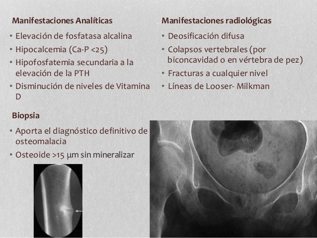 41 osteoporosis osetomalacia 41 osteoporosis osetomalacia