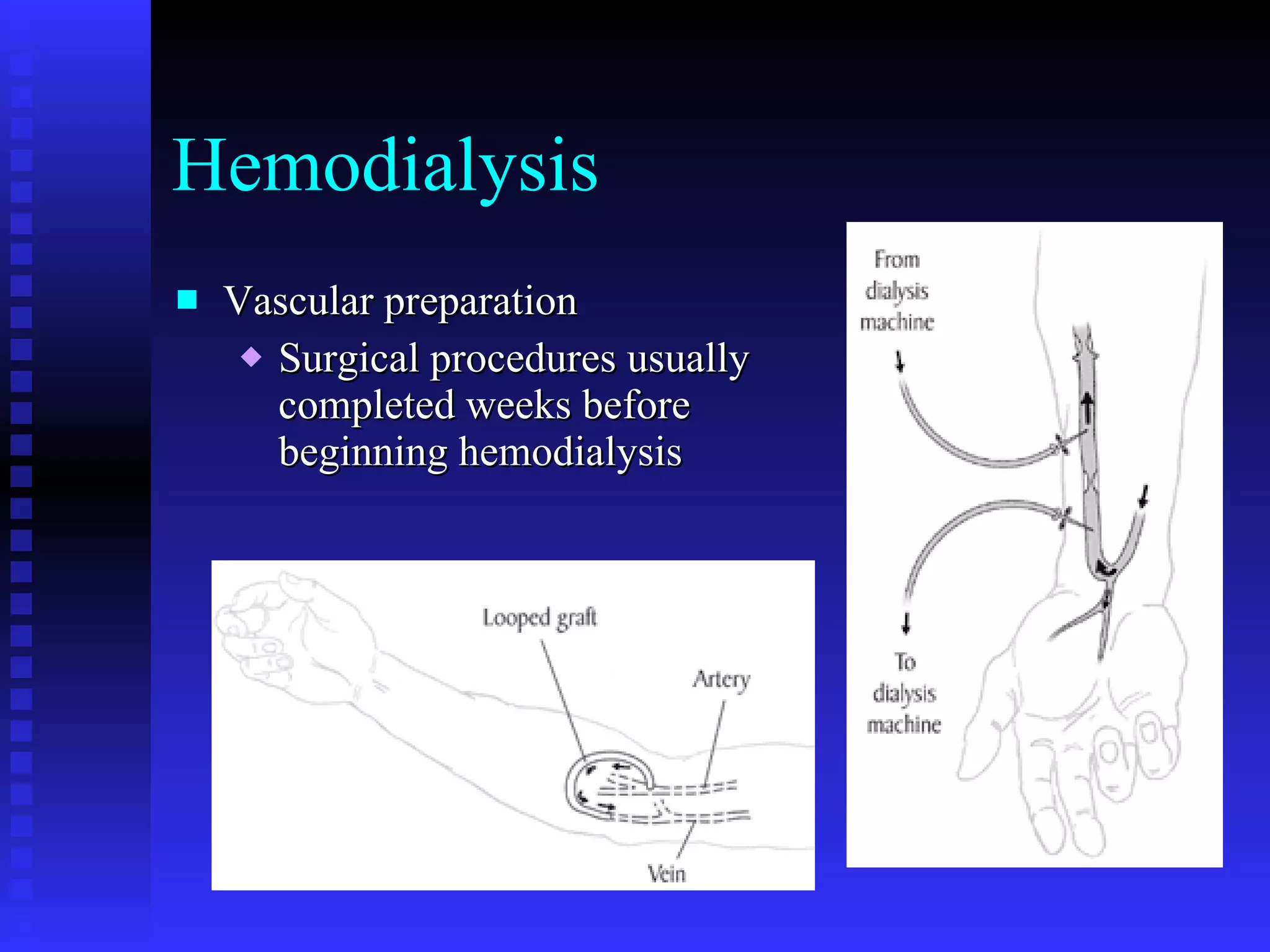 Hemodialysis Vascular preparation Surgical procedures usually completed weeks before beginning hemodialysis 