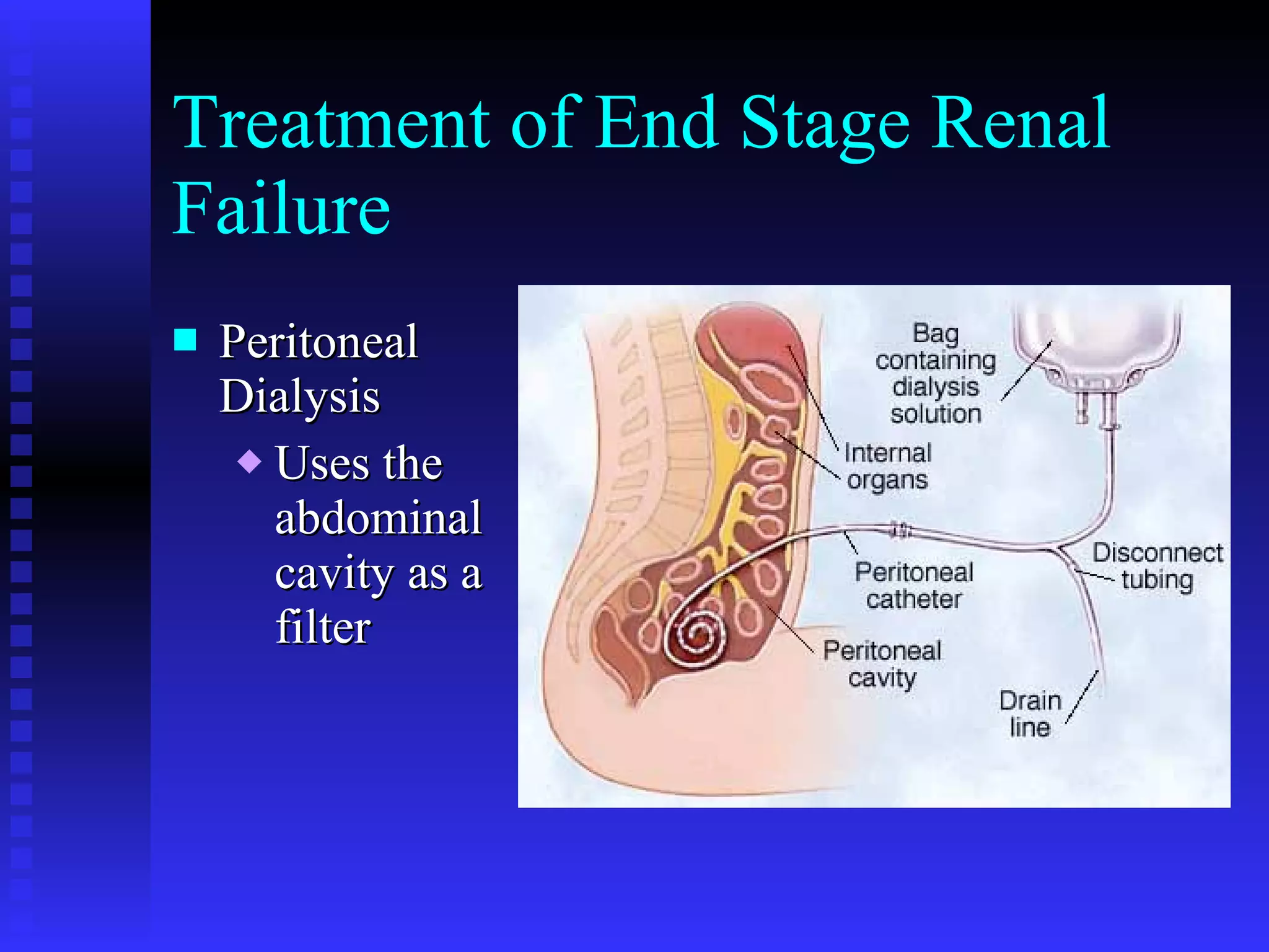 Treatment of End Stage Renal Failure Peritoneal Dialysis Uses the abdominal cavity as a filter 