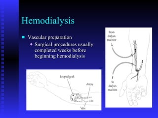 Hemodialysis Vascular preparation Surgical procedures usually completed weeks before beginning hemodialysis 