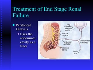 Treatment of End Stage Renal Failure Peritoneal Dialysis Uses the abdominal cavity as a filter 