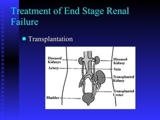 Treatment of End Stage Renal Failure Transplantation 