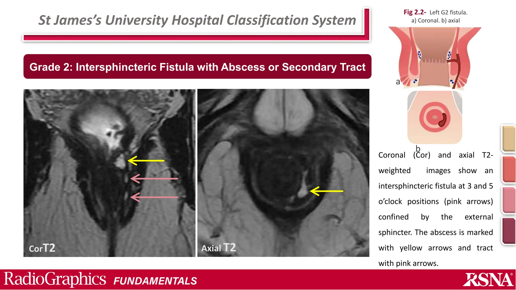 Simple Abscess Perianal fistula and Abscess.pptx