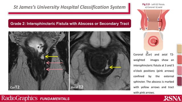 Perianal fistula and Abscess.pptx | Digestive Disorders | Diseases and ...