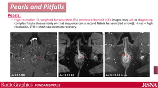 Perianal fistula and Abscess.pptx