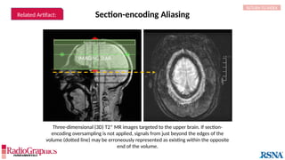 IMAGING SLAB
Section Level
Section-encoding Aliasing
RETURN TO INDEX
Three-dimensional (3D) T2* MR images targeted to the upper brain. If section-
encoding oversampling is not applied, signals from just beyond the edges of the
volume (dotted line) may be erroneously represented as existing within the opposite
end of the volume.
Related Artifact:
 