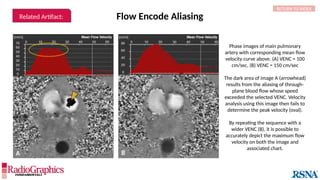 Flow Encode Aliasing
RETURN TO INDEX
Related Artifact:
A B
Phase images of main pulmonary
artery with corresponding mean flow
velocity curve above. (A) VENC = 100
cm/sec, (B) VENC = 150 cm/sec
The dark area of image A (arrowhead)
results from the aliasing of through-
plane blood flow whose speed
exceeded the selected VENC. Velocity
analysis using this image then fails to
determine the peak velocity (oval).
By repeating the sequence with a
wider VENC (B), it is possible to
accurately depict the maximum flow
velocity on both the image and
associated chart.
 