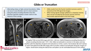 Description
Causes
Gibbs or Truncation
A
 Phase Direction 
RETURN TO INDEX
(A) Sagittal T2W cervical MR image with FOV = 240 mm, matrix (frequency-encoding direction [f] ×
phase-encoding direction [p]) = 272 × 256. Gibbs (arrowheads) is common in the spine and may
interfere with the depiction of spinal cord contusions or mimic a syrinx. Out-of-phase (B) and in-phase
(C) axial T1W abdominal GRE MR images with truncation artifacts (arrowheads) along the margins of
organs. Small lesions along the lateral liver and spleen can be overlooked because of this artifact.
• Gibbs results from the Fourier transform process used to
reconstruct the MR signal into images.
• When strong signals change suddenly in a stepwise manner,
they can be truncated by the Fourier process and thus
inaccurately approximated in the final image.
Alternating stripes at high-contrast boundaries. Gibbs
can occur in any direction, but it is most common
along the phase-encoding direction since this
direction typically employs a lower matrix in the
interest of time savings.
B

Phase
Direction

C
 