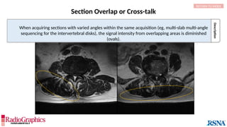Description
When acquiring sections with varied angles within the same acquisition (eg, multi-slab multi-angle
sequencing for the intervertebral disks), the signal intensity from overlapping areas is diminished
(ovals).
Section Overlap or Cross-talk
RETURN TO INDEX
 