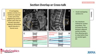 Section Overlap or Cross-talk
Causes
Solutions
• Avoid overlapping
sections (C)
A B
C D
Interference is
lessened
• Use interleave
method for section
acquisition. This
increases the time
between adjacent
section encodes,
thus allowing spins
to relax before they
are excited again
(D)
RETURN TO INDEX
If overlapping
sections (circles in A
and B) are acquired
at the same time,
neighboring sections
contain spins that are
already saturated,
leading to diminished
signal intensity in
shared areas
 