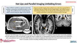 Causes
Unique to parallel imaging, these artifacts occur when the acquired FOV or
calibration data are smaller than the imaged object, with artifact location
depending on R-factor. This can also be seen at 3D imaging when section
encode acceleration is used with insufficient section coverage.
Hot Lips and Parallel Imaging Unfolding Errors
(A) Axial T1W MR image of the liver with FOV (f x p) = 400 x 360 mm, R-factor = 2. Adipose tissue has been incorrectly unfolded
into the abdominal cavity (arrowheads). Image (B) shows a sagittal 3D T1 magnetization-prepared rapid gradient echo (MPRAGE)
with a pseudolesion seen on the axial MPR. Review of a coronal multiplanar reformation (C) at the same level reveals that the
lesion is actually a section-encoding unfolding artifact caused by the ear.
C
RETURN TO INDEX
HOT LIPS
A
Description
These artifacts manifest as signal or noise that
overlays a somewhat centralized location on the
image. This is different from normal aliasing,
which is found along the edges of the volume.
B
 