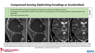 Solutions
Compressed Sensing (Optimizing Encodings or Acceleration)
• Increase PE matrix or add oversampling to increase the number of encodings in k-space.
• If averaging is not specifically needed, convert NSA to oversampling, as oversampling supports random sparsity more
effectively.
• Decrease acceleration factor.
PD FS MR images of the knee obtained with compressed sensing (scan duration = ~45 seconds). Image (A) is filling k-space with 250 encodings and accelerated by a factor of 4. Image
(B) is filling k-space with 375 encodings and is accelerated by a factor of 3.3. The ratio of encodings to acceleration factor is higher in (B), resulting in superior image quality. Coronal
T2W MR images through the hippocampus with 2 NSA (C) and 2 oversampling (D). Note that even though both sequences have exactly the same matrices (320 x 320) and scan time,
cortical delineations are slightly clearer on image (D).
A B
C
D
C
 