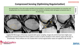 Solutions
Compressed Sensing (Optimizing Regularization)
C
Set regularization in-line with vendor-specified recommendations: exceeding recommendations can cause blur, and
dropping below the recommendation can result in the retention of aliasing, which will appear as textured noise, in
the final image.
Sagittal PD MR images of the knee acquired with sparse sampling. Images (A) and (C) have been highly over-
regularized and demonstrate fine linear patterns (ovals) as well as striations in the anterior aspect of the ACL (C,
arrowheads). These artifacts are not created when normal regularization values are applied to (B) and (D).
A C
B D
RETURN TO INDEX
 
