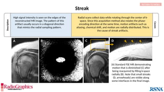 Streak
RETURN TO INDEX
(A) Standard FSE MR demonstrating
motion that is diminished (C) after
being reacquired by filling k-space
radially (B). Note that small streaks
(D, arrowheads) are visible along
some interfaces in the final image.
A B C D
Description
High signal intensity is seen on the edges of the
reconstructed MR image. The pattern of this
artifact usually occurs in a diagonal direction
that mimics the radial sampling pattern.
Causes
Radial scans collect data while rotating through the center of k-
space. Since this acquisition method also rotates the phase-
encoding direction at the same time, motion artifacts such as
aliasing, chemical shift, and motion are radially distributed. This is
the cause of streak artifacts.
 