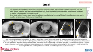 Solutions
Streak
A B
Axial UTE contrast-enhanced MR images of the lung in a patient with a history of COVID-19. Image (A) was acquired with a 20-second BH using 5 220
trajectories. Image (B) was performed with 44 730 trajectories with respiratory gating across 5 minutes. Streak artifacts (arrowheads) interfere with evaluation
of the lung parenchyma. Reduction of streak artifact (as well as increased clarity) is appreciable. UTE cardiac short axis. (C) FOV = 320 mm, (D) FOV = 450 mm.
Streak artifacts that interfere with visualization of the mediastinum (C, arrowheads) are reduced by increasing FOV (D). However, it should be noted that
increasing the FOV does not change the streak artifacts around the edge of tissues (D, arrowheads).
• The impact of streak artifacts can be reduced by increasing the number of trajectories used for acquisition. This will
result in finer streaking, and with high enough trajectory values, streaks may become nearly imperceptible. However,
increasing trajectories will increase scan time.
• Since streak artifact is often exacerbated by radially encoded aliasing, increasing FOV such that all anatomy is properly
encoded can also reduce the impact of this artifact.
RETURN TO INDEX
C D
 