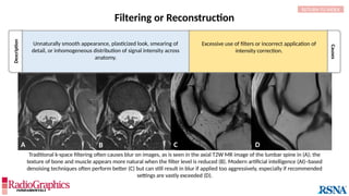 C D
A B
Filtering or Reconstruction
Traditional k-space filtering often causes blur on images, as is seen in the axial T2W MR image of the lumbar spine in (A); the
texture of bone and muscle appears more natural when the filter level is reduced (B). Modern artificial intelligence (AI)–based
denoising techniques often perform better (C) but can still result in blur if applied too aggressively, especially if recommended
settings are vastly exceeded (D).
Description
Unnaturally smooth appearance, plasticized look, smearing of
detail, or inhomogeneous distribution of signal intensity across
anatomy.
Causes
Excessive use of filters or incorrect application of
intensity correction.
RETURN TO INDEX
 