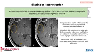 Solutions
Axial postcontrast T1W SE MR images of the
brain with a denoising algorithm (A)
compared with a k-space filter (B).
While both SNR and contrast-to-noise ratio
(CNR) are elevated in (A), some small hollows
are not clearly visualized (oval). In addition,
Gibbs ringing is emphasized (arrowhead).
On the other hand, (B) shows less Gibbs
artifacts and better displays fine details but is
a bit noisy.
Filtering or Reconstruction
RETURN TO INDEX
A B
Familiarize yourself with the postprocessing options of your vendor. Image feel can vary greatly
depending the postprocessing that is applied.
 