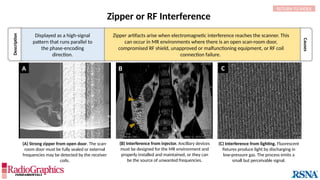 A C
B
Description
Causes
Zipper or RF Interference
RETURN TO INDEX
Displayed as a high-signal
pattern that runs parallel to
the phase-encoding
direction.
Zipper artifacts arise when electromagnetic interference reaches the scanner. This
can occur in MR environments where there is an open scan-room door,
compromised RF shield, unapproved or malfunctioning equipment, or RF coil
connection failure.
(B) Interference from injector. Ancillary devices
must be designed for the MR environment and
properly installed and maintained, or they can
be the source of unwanted frequencies.
(A) Strong zipper from open door. The scan-
room door must be fully sealed or external
frequencies may be detected by the receiver
coils.
(C) Interference from lighting. Fluorescent
fixtures produce light by discharging in
low-pressure gas. The process emits a
small but perceivable signal.
 