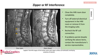 • Close the MRI room door
completely.
• Turn off external electrical
equipment in the MRI
room or remove it from
the imaging suite.
• Recheck the RF coil
connection.
• If problems persist despite
verifying the above items,
contact the manufacturer’s
service representative.
Solutions
Door open Door closed
Zipper or RF Interference
RETURN TO INDEX
Sagittal T1W MR images of the lumbar spine with zipper artifact (arrowheads) overlaying
anatomy of interest.

Phase
Direction

 