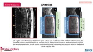 Annefact
(A) Sagittal T2W MR images of the thoracic spine. Artifact runs head to foot but is not from radiofrequency; it is
annefact. Annefact (arrowheads) results from the capture of frequencies outside of the homogeneous magnetic
field. Preventive measures include limiting the number of receive elements (C) and properly centering the patient
to the magnetic field.
Area
of
magnetic
homogeneity
1
4
3
2
Active
Elements
4
3
2
1
Active
Elements
Area
of
magnetic
homogeneity

Phase
Direction

RETURN TO INDEX
A C
B
Similar to Zipper:
 