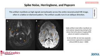 Description
Spike Noise, Herringbone, and Popcorn
This artifact manifests as high signals (arrowheads) across the entire reconstructed MR image,
often in a lattice or diamond pattern. The artifact usually runs in an oblique direction.
B
Spike artifact most often manifests on
echo-planar sequencing owing to the
stress that echo-planar imaging (EPI)
places on system components.
In (A) and (B), we see two separate
occurrences captured on standard
clinical DWI (b value = 1000)
A
RETURN TO INDEX
 